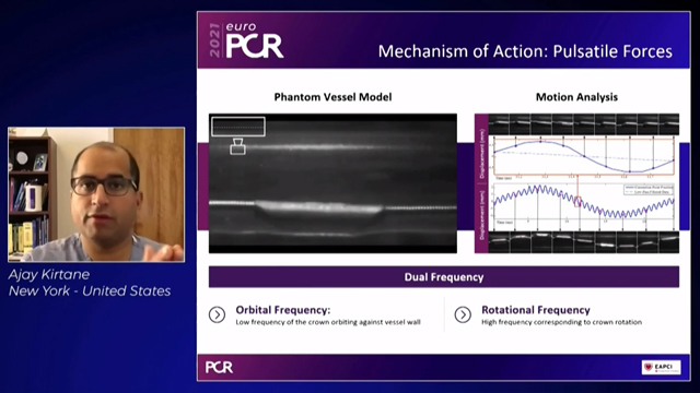 Latest insights: when to choose orbital atherectomy