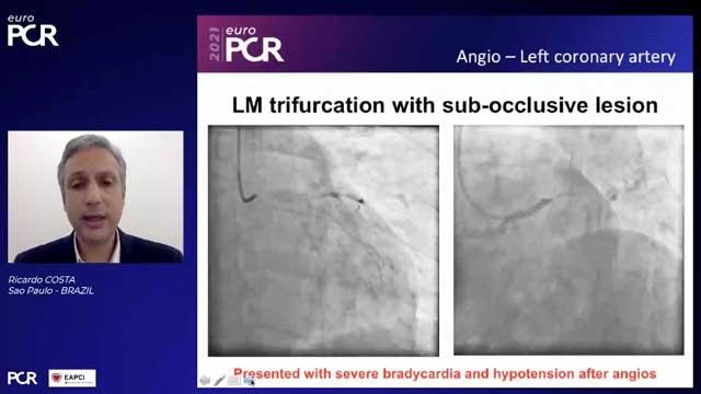 LM trifurcation STEMI