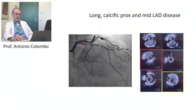 MagicTouch sirolimus coated balloon continues to be the choice of treatment for CAD