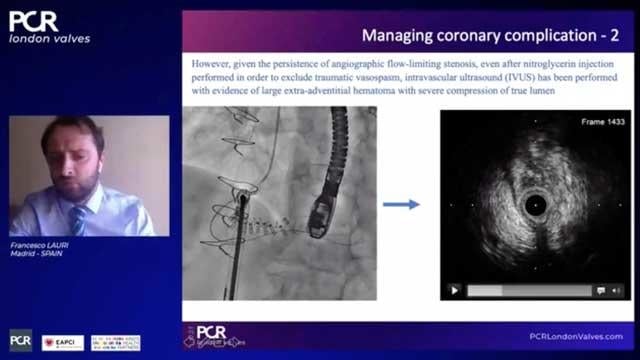 Unusual situations in valvular interventions