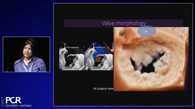 Mitral valve disease: diagnosis and treatment selection