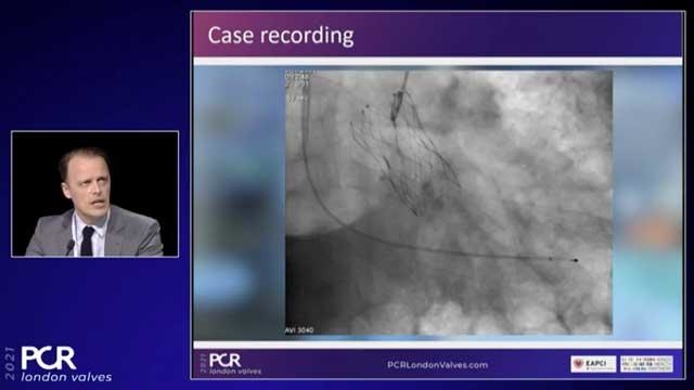 The Navitor with FlexNav TAVI system: when smooth implantability allows to optimise TAVI outcomes