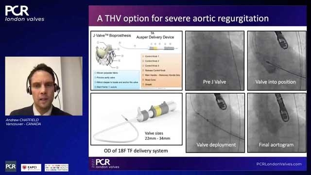 Outcomes of TAVI devices