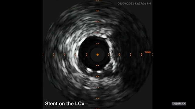PCI of calcified coronaries - we will rock you! - Part 3