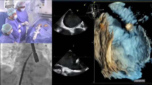 Percutaneous mitral treatment: repair
