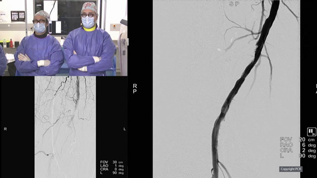 SFA and popliteal interventions (part 2)
