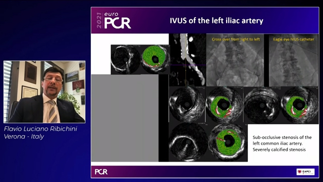 Shock the Rock: new intravascular lithotripsy real-world data and cases