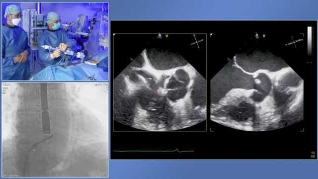 Tailoring mitral and tricuspid dedicated clip therapies by unlocking their full potential