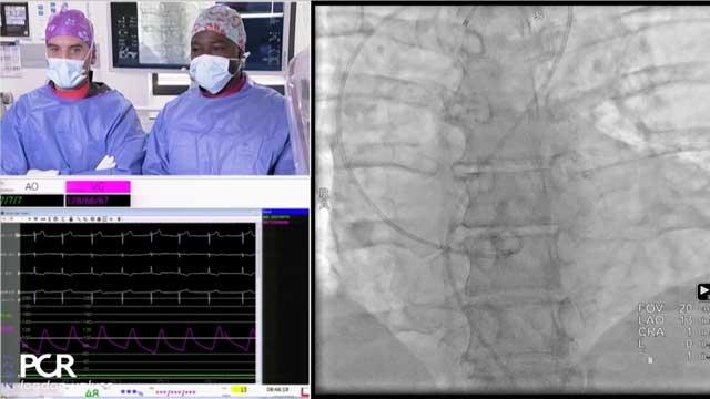 TAVI in bicuspid aortic valves: optimal technique and procedural refinement