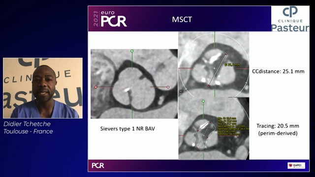 TAVI in bicuspid aortic valve patients. SAPIEN 3 platform, a safe and efficient option