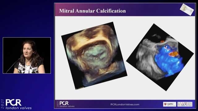 Transcatheter mitral valve replacement: patient selection and hemodynamic stability
