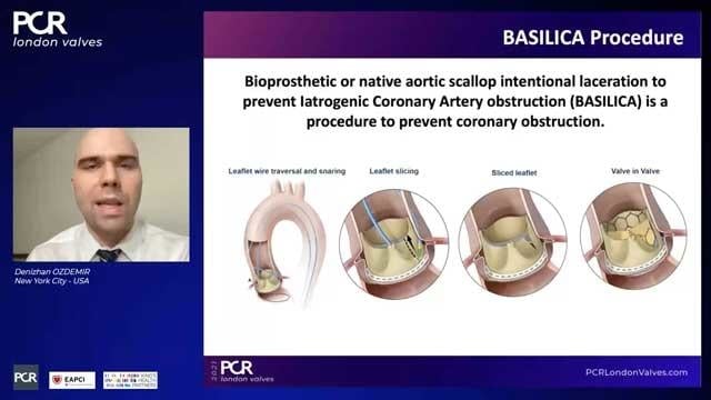 Transcatheter aortic valve-in-valve