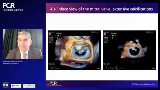 Transcatheter edge-to-edge repair