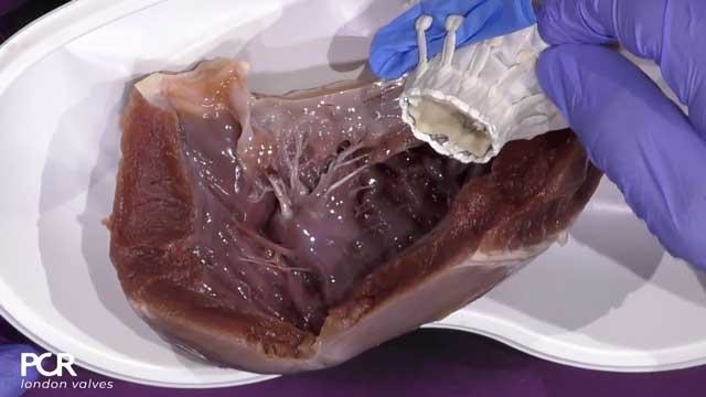 Transcatheter mitral valve implantation