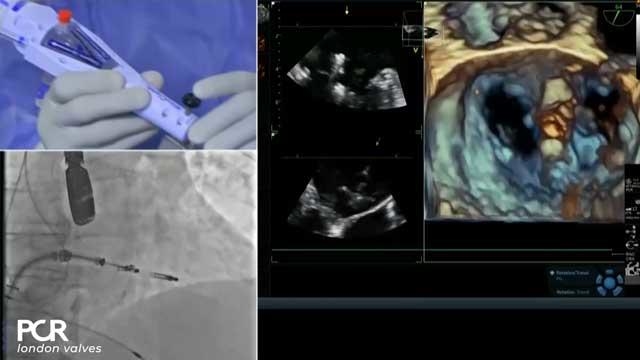 Transcatheter mitral valve repair and replacement: optimal technique and procedural refinement