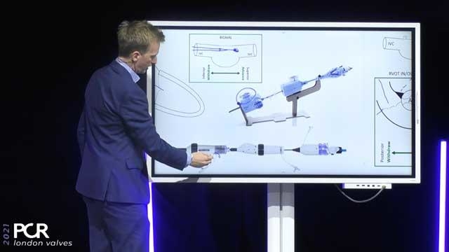 Transcatheter tricuspid valve interventions: optimal technique and procedural refinement
