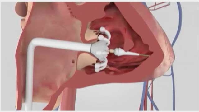 Transcatheter tricuspid valve interventions: the future