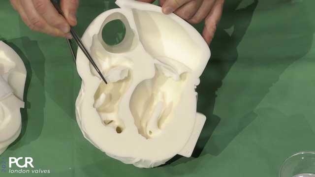 Transcatheter tricuspid valve replacement
