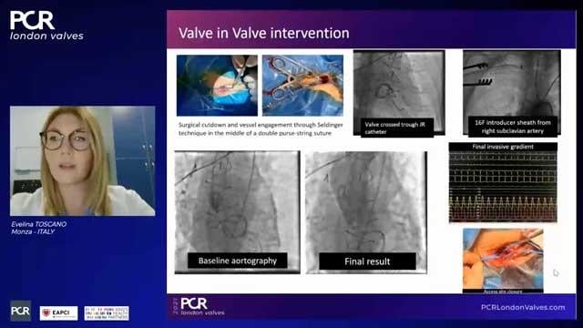 Unfavorable access in TAVI