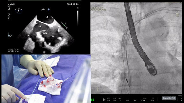 Treatment of severe tricuspid regurgitation
