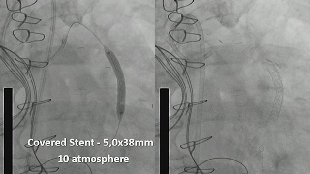 Angina: when coronary curtery is not the problem