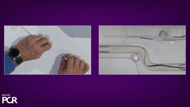 Antegrade CTO - The techniques