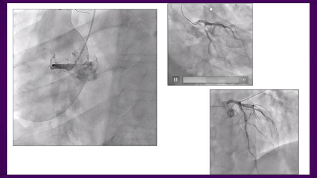 Antithrombotics in practice after PCI: from evidence to individual patient management