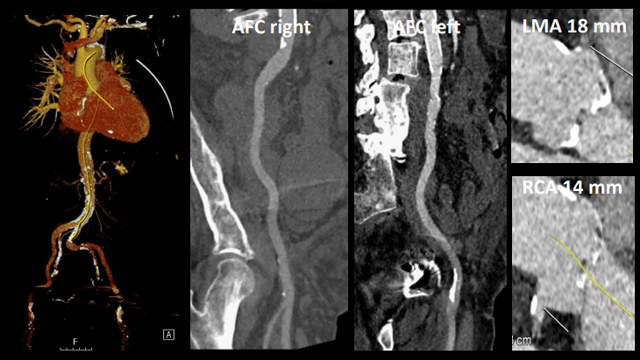 Aortic stenosis and concomitant mitral valve disease