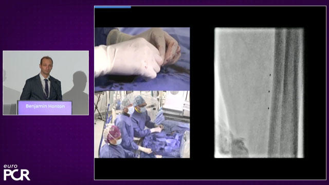 Below-the-knee angioplasty for critical limb ischemia