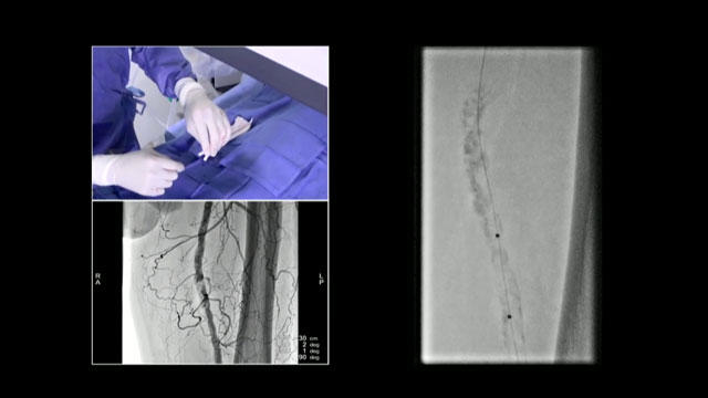 Bending zones last frontier for peripheral angioplasty