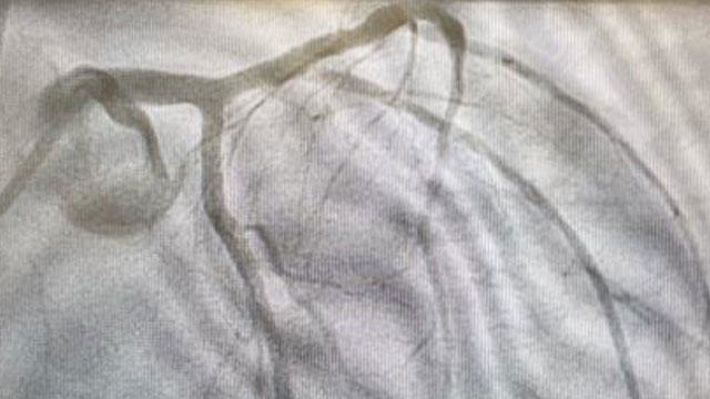 Bifurcation lesion - Tools, devices and techniques