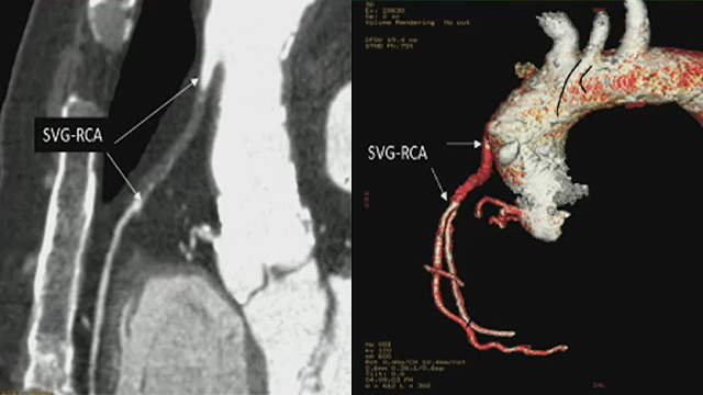 Calcifications may still be challenging