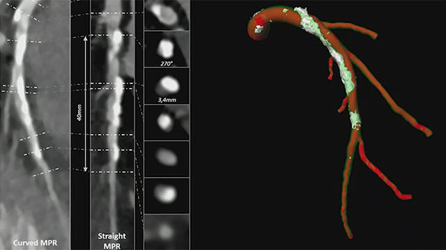 Calcified lesions: which tools do you choose