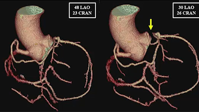 Challenging coronary case: anatomical complexity on top of a CTO