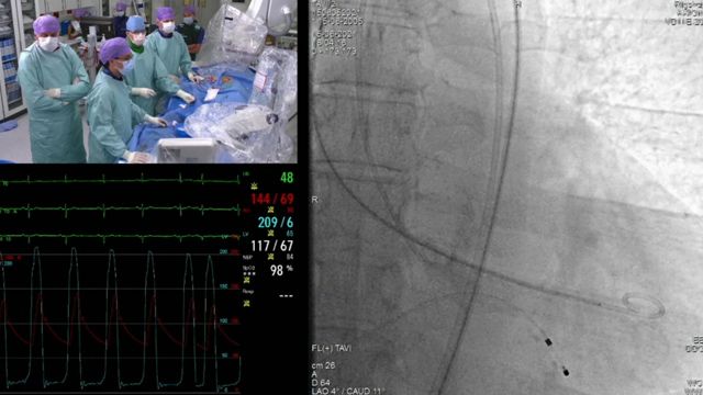 Challenging scenarios: bicuspid aortic valves
