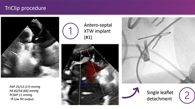 Challenging scenarios during transcatheter tricuspid valve intervention