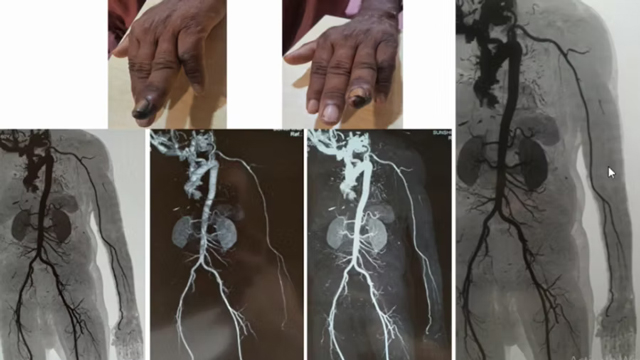 Clinical Cases on Peripheral Interventions
