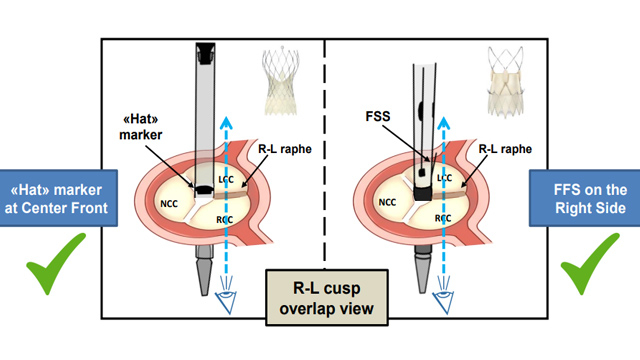 Clinical outcomes after TAVI: Session 1