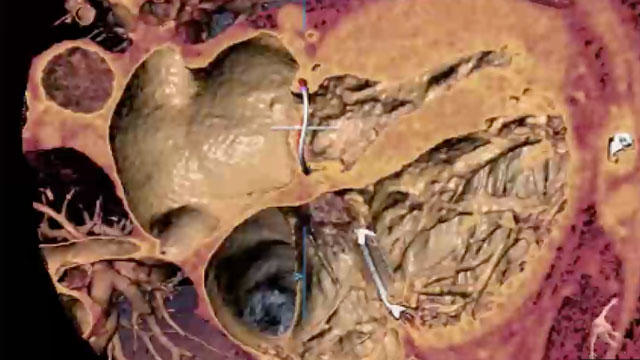 Combined valve interventions