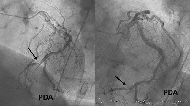 Complex PCI leading to complex complications