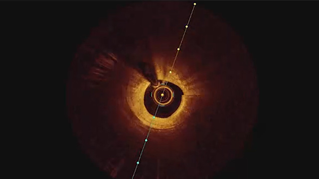 Complex PCI: tips and tricks