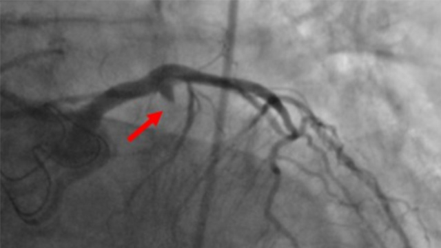 Complex primary PCI (part II)