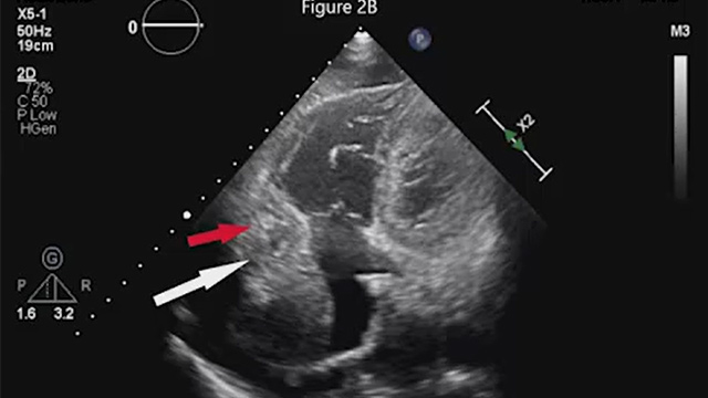 Complications following primary PCI