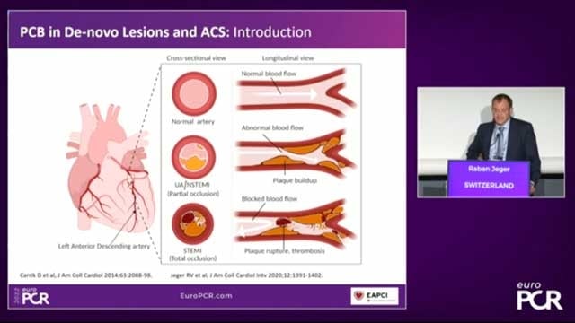 The current role of paclitaxel DCB in PCI