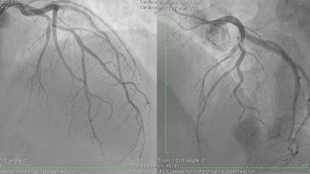 Dealing with calcified lesions: friends and enemies