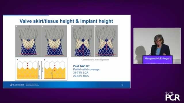 Double jeopardy: coronary disease in patients undergoing TAVI