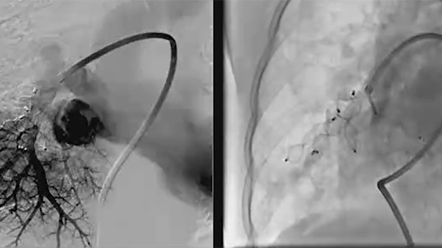Endovascular pulmonary hypertension treatment