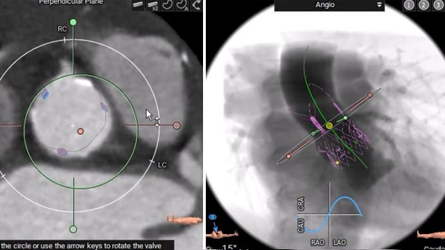 Ensuring optimal TAVI outcomes