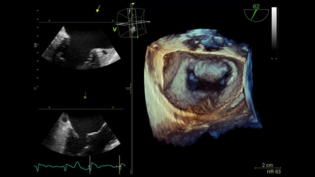 EuroPCR 2022 Hotlines / Late-Breaking Trials in mitral and tricuspid: MITRA-TUNE, MitraBridge, TriCLASP, CLASP TR, and more!