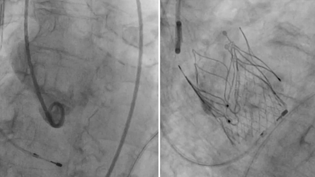 EuroPCR 2022 Hotlines / Late-Breaking Trials in TAVI: Optimize PRO, FORWARD PRO, Neo-Align, and more!